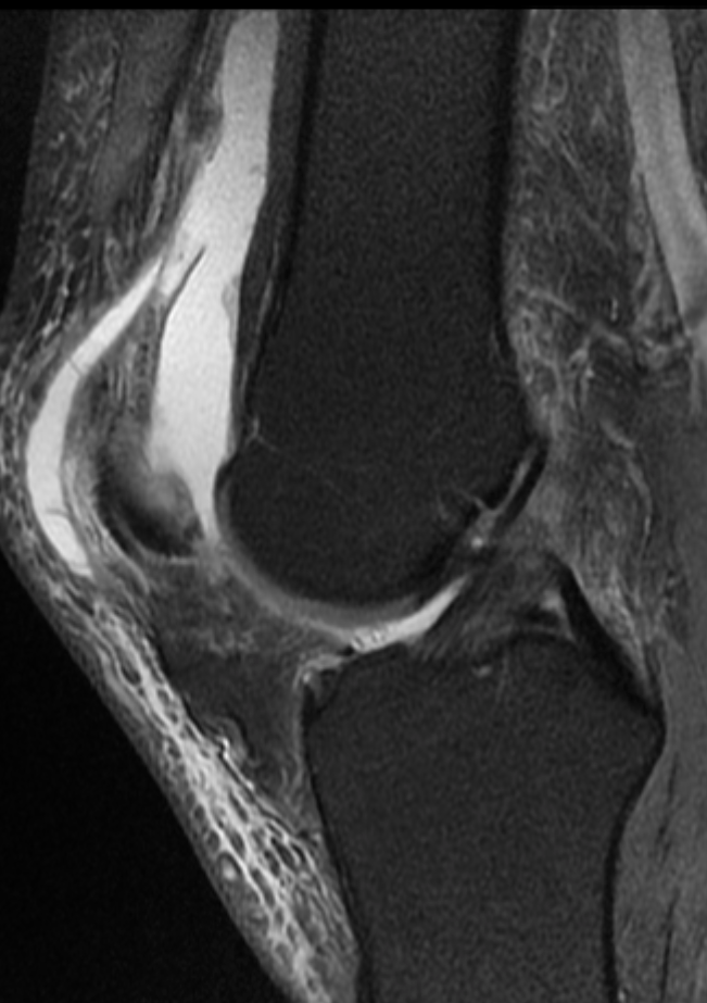 
Quadriceps tear. Click for DICOM
