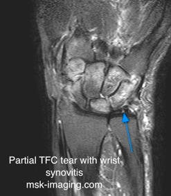 TFCC imaging