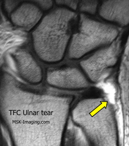 TFCC anatomy